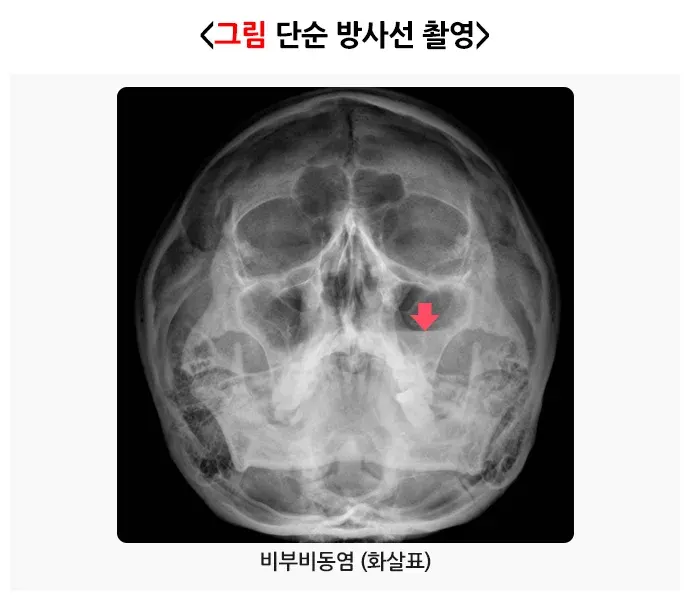 비부비동염 진단 및 검사 설명 이미지 3