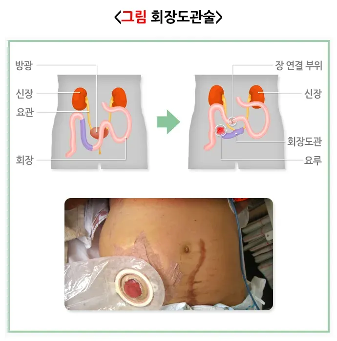 요로전환술(회장도관술) 치료 방법 설명 이미지 1