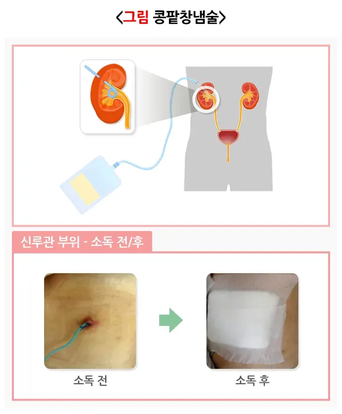 요로전환술(콩팥창냄술) 치료 방법 설명 이미지 1