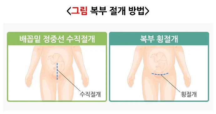 제왕절개술 치료 방법 설명 이미지 1