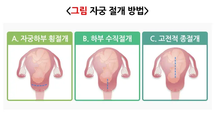 제왕절개술 치료 방법 설명 이미지 2