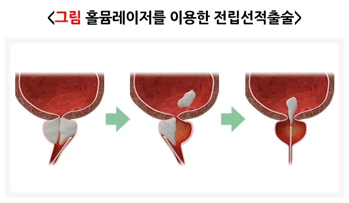 전립선비대증 비약물 치료 설명 이미지 3