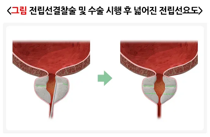전립선비대증 비약물 치료 설명 이미지 4