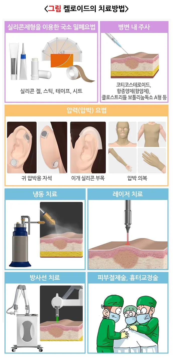 켈로이드 치료 설명 이미지 1