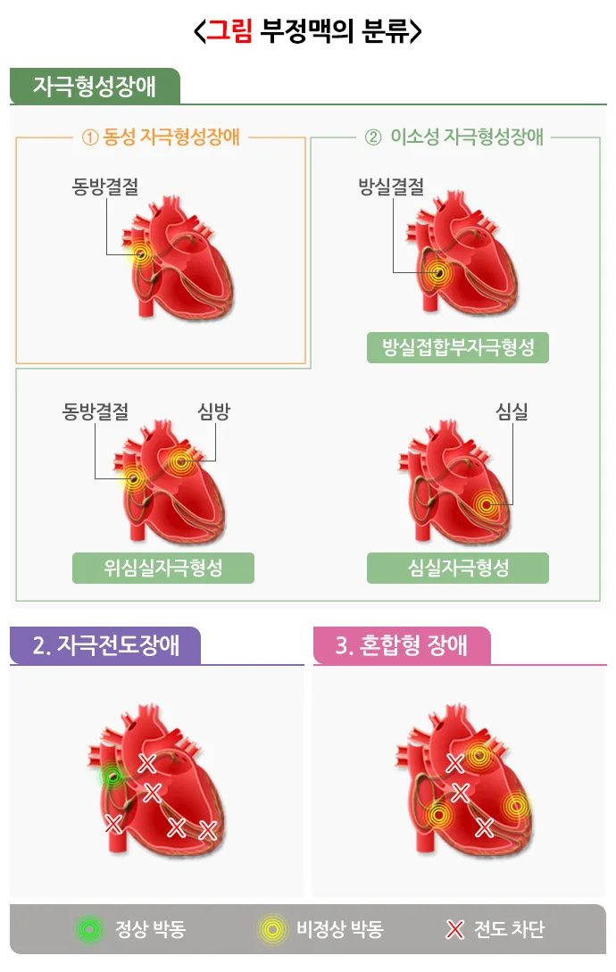 부정맥 종류 설명 이미지 1