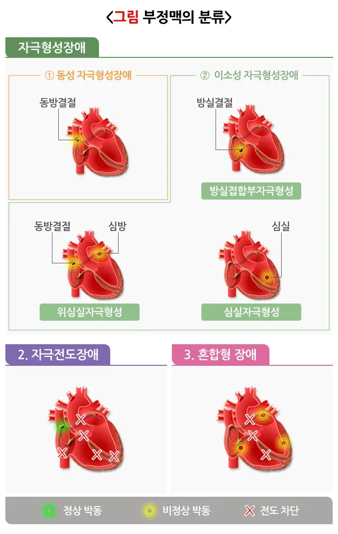 부정맥 종류 설명 이미지 1