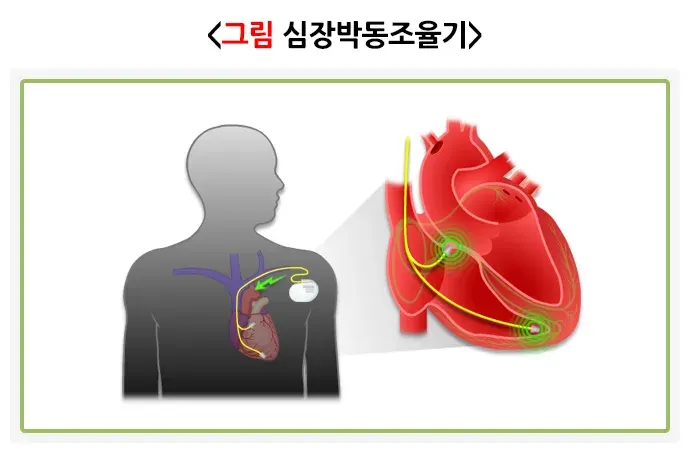 부정맥 비약물 치료 설명 이미지 1