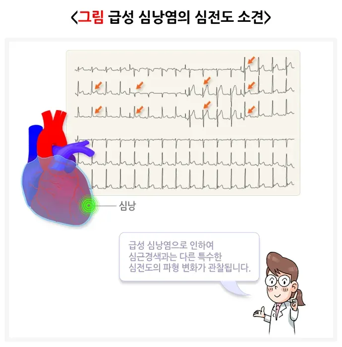 심낭염(급성 심낭염) 진단 및 검사 설명 이미지 1