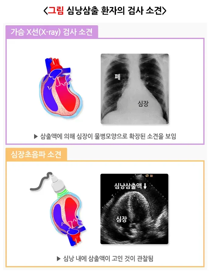 심낭염(만성 심낭삼출) 진단 및 검사 설명 이미지 1