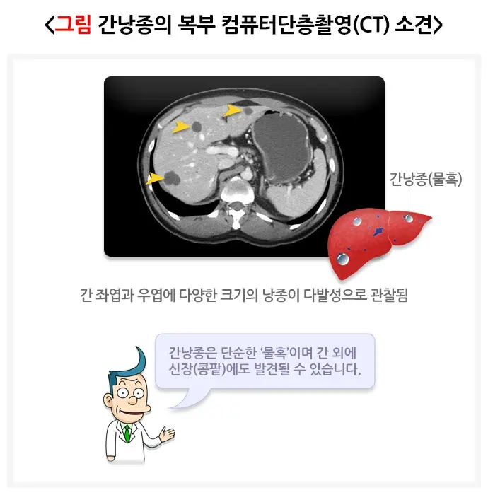 간의 양성종양(간낭종) 진단 및 검사 설명 이미지 1