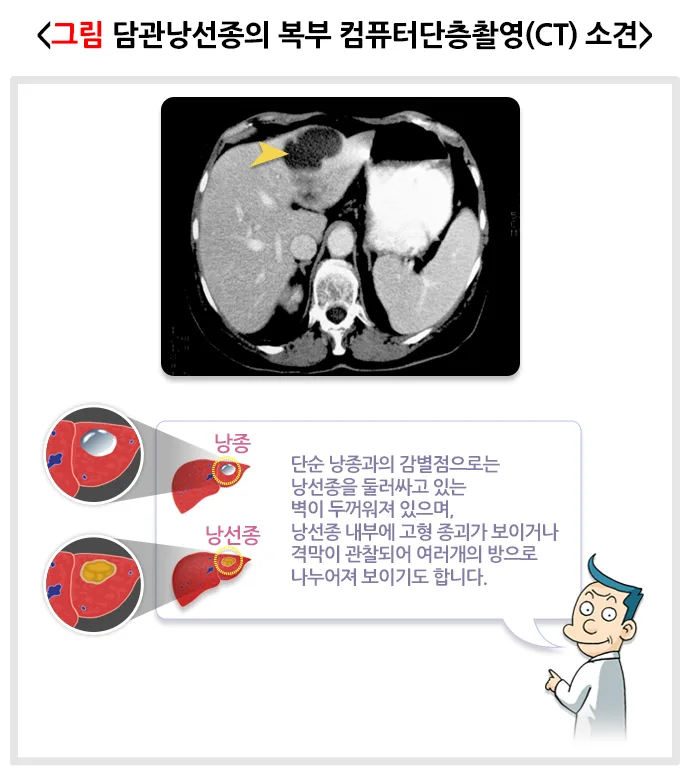 간의 양성종양(담관낭선종) 진단 및 검사 설명 이미지 1