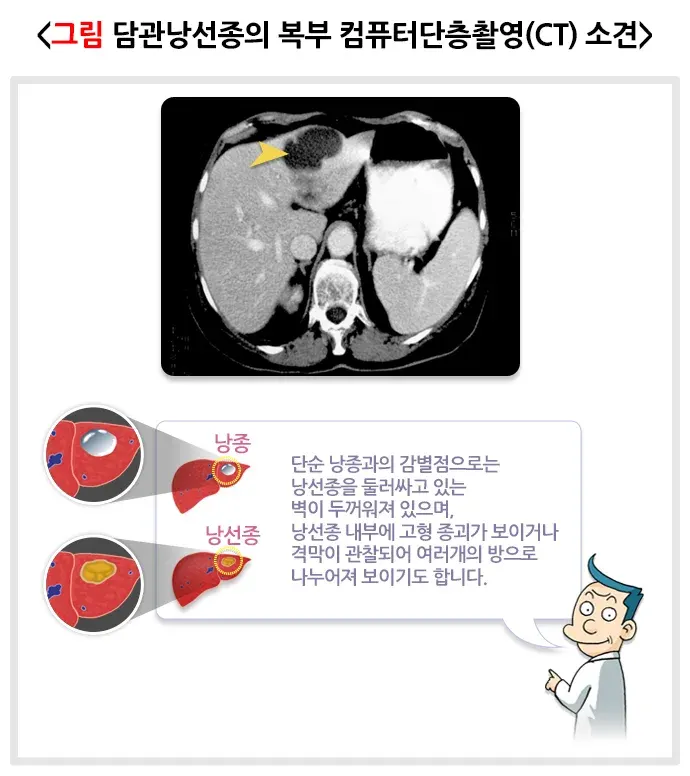 간의 양성종양(담관낭선종) 진단 및 검사 설명 이미지 1