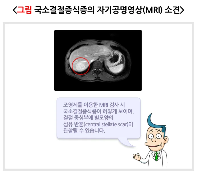 간의 양성종양(국소결절증식증) 진단 및 검사 설명 이미지 1