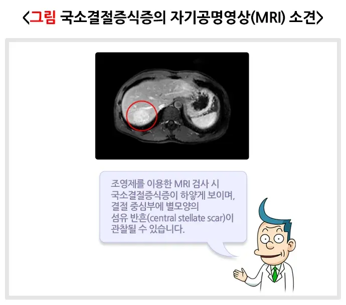 간의 양성종양(국소결절증식증) 진단 및 검사 설명 이미지 1
