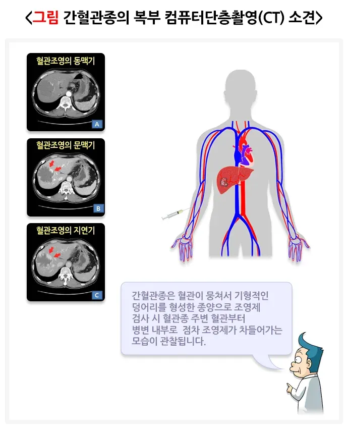 간의 양성종양(간혈관종) 진단 및 검사 설명 이미지 1