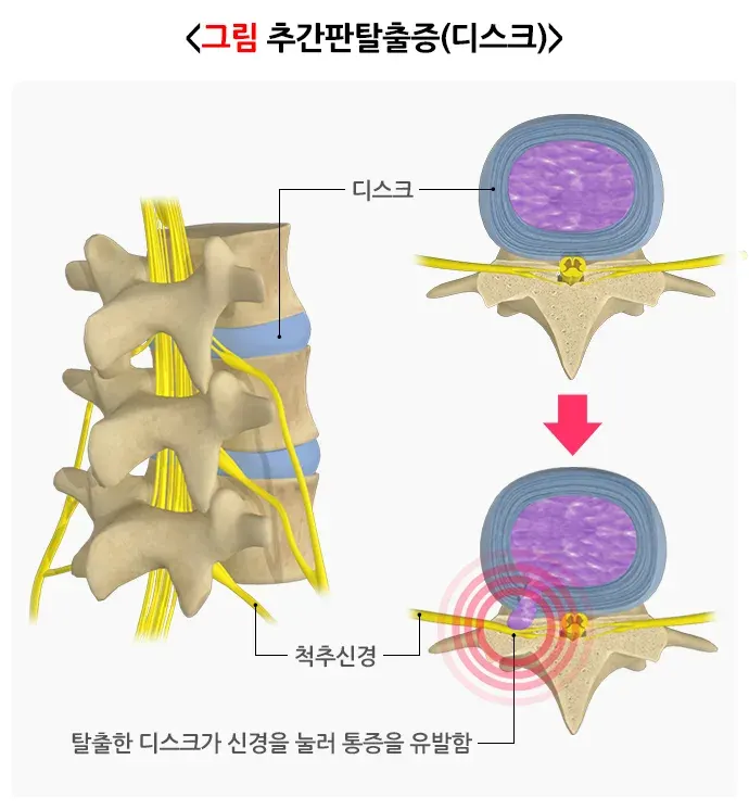 추간판탈출증(디스크) 정의 설명 이미지 1