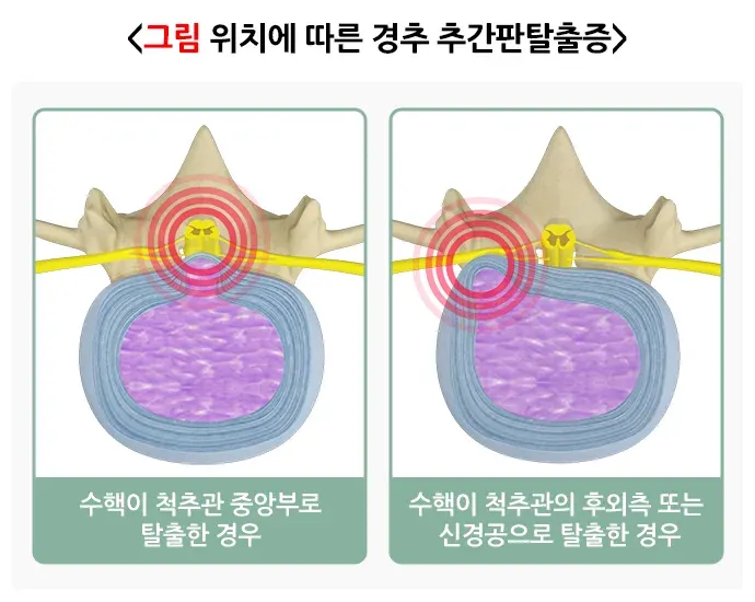 추간판탈출증(디스크) 증상 설명 이미지 2