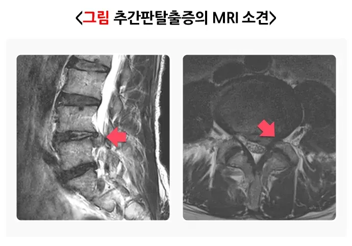 추간판탈출증(디스크) 진단 및 검사 설명 이미지 2