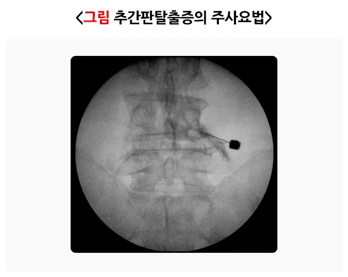 추간판탈출증(디스크) 비약물 치료 설명 이미지 1