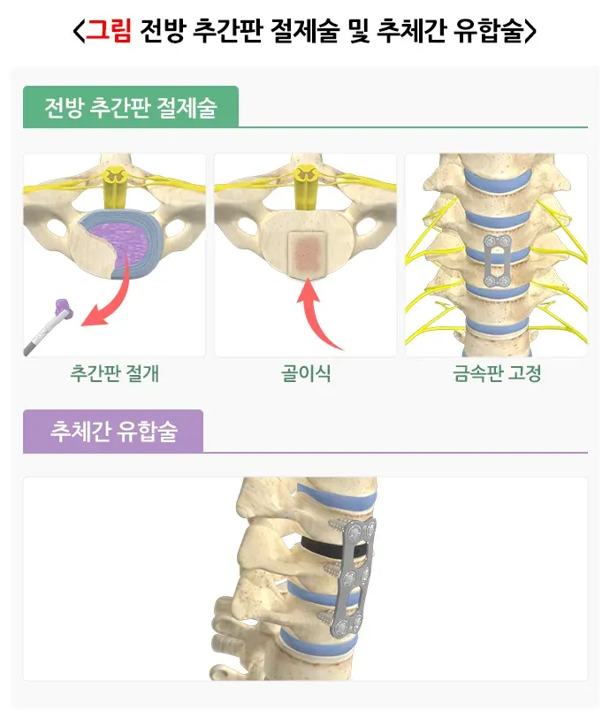 추간판탈출증(디스크) 비약물 치료 설명 이미지 3
