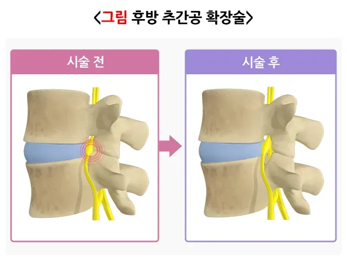 추간판탈출증(디스크) 비약물 치료 설명 이미지 4