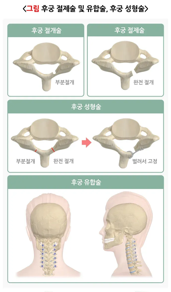 추간판탈출증(디스크) 비약물 치료 설명 이미지 5