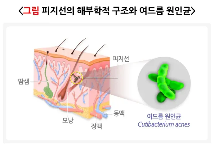 여드름 원인 설명 이미지 1