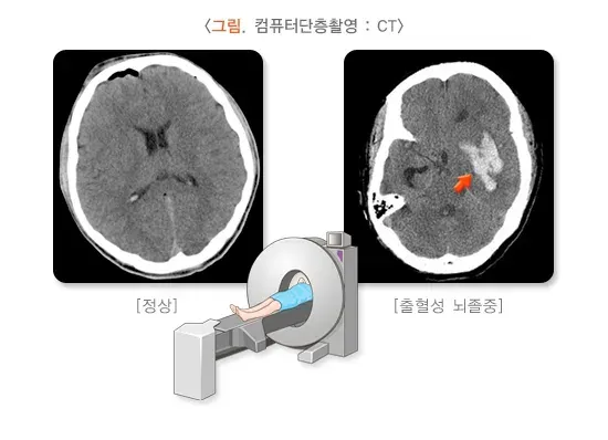 일과성 허혈 발작 진단 및 검사 설명 이미지 1