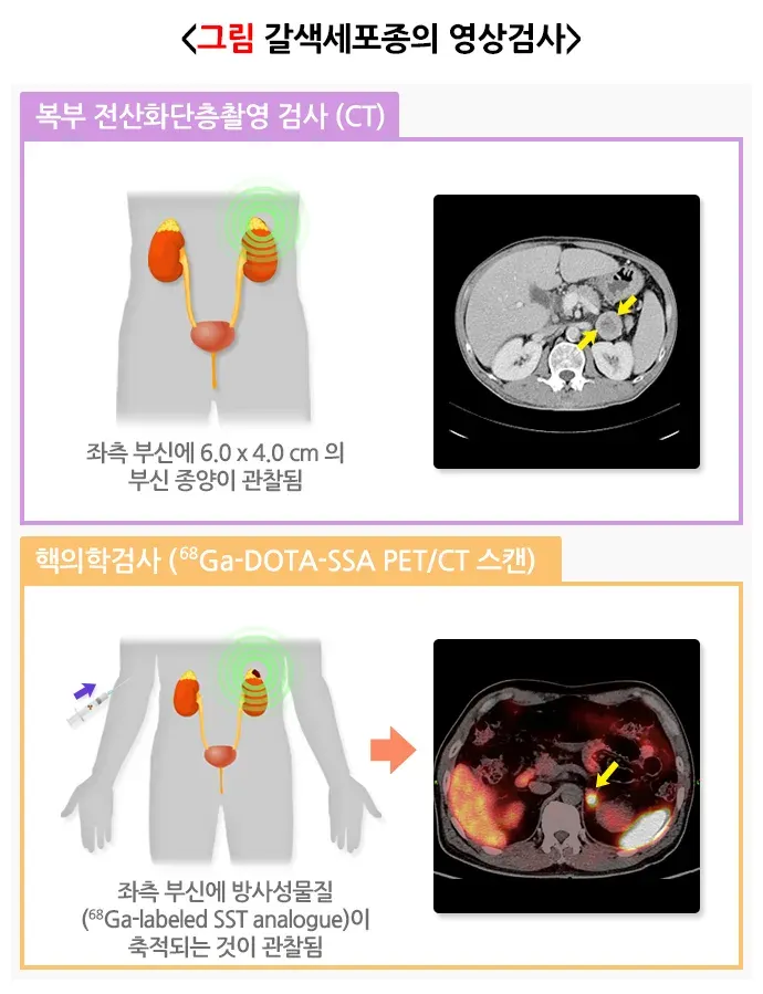 갈색세포종 진단 및 검사 설명 이미지 1