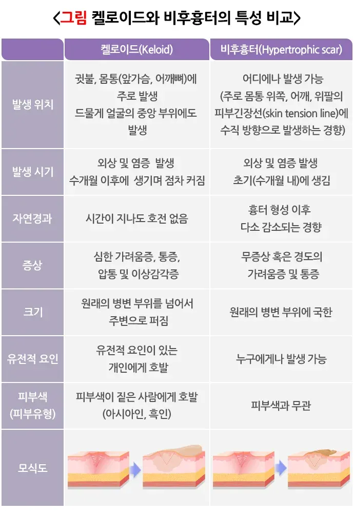 켈로이드 진단 및 검사 설명 이미지 1