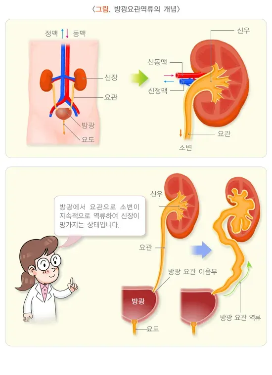방광요관역류(소아) 정의 설명 이미지 1