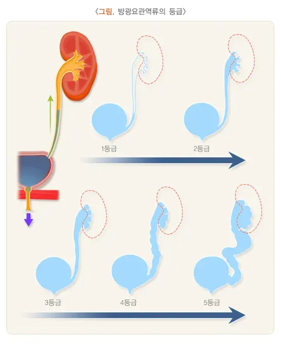 방광요관역류(소아) 종류 설명 이미지 1