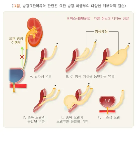 방광요관역류(소아) 종류 설명 이미지 2