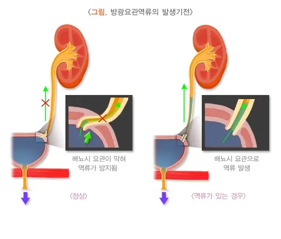 방광요관역류(소아) 병태생리 설명 이미지 1
