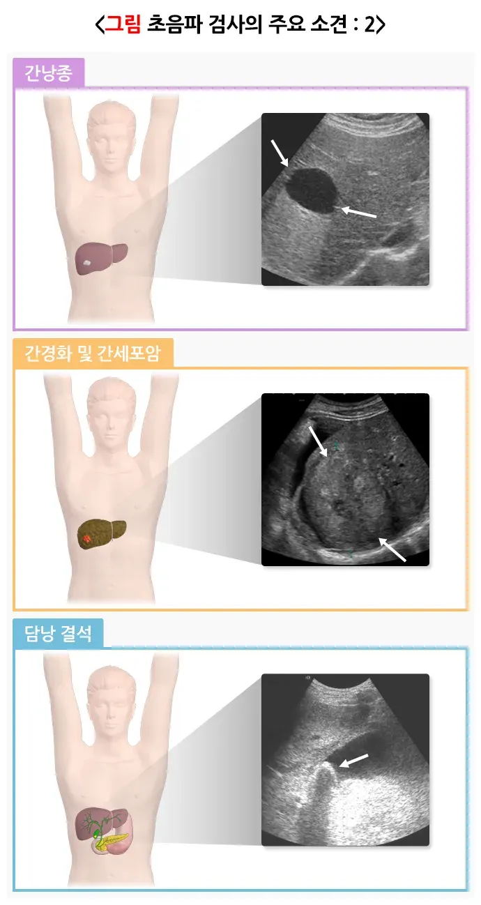 복부초음파검사 검사 결과 해석 설명 이미지 2