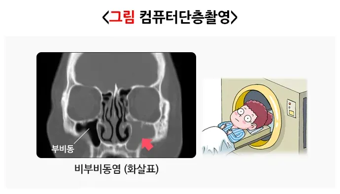비부비동염 진단 및 검사 설명 이미지 4