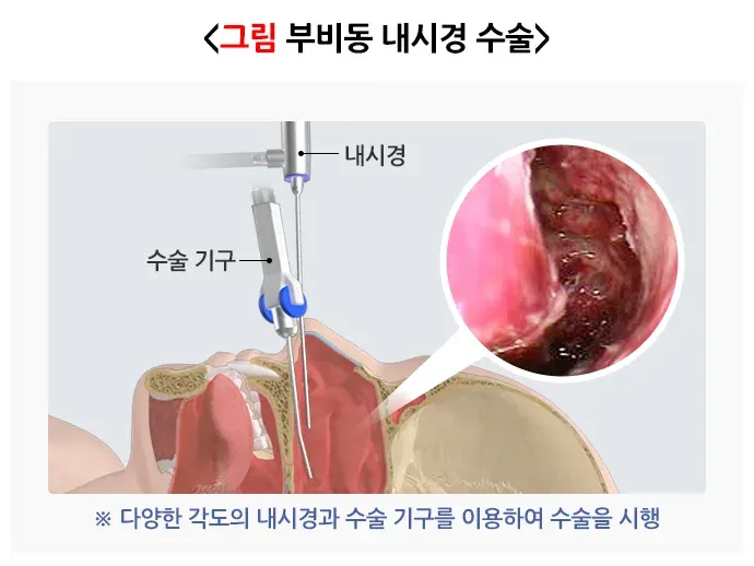 비부비동염 치료 설명 이미지 4