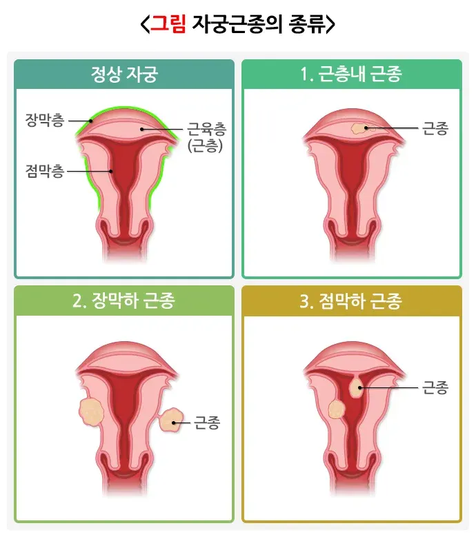 자궁근종 종류 설명 이미지 1