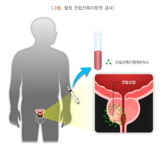 전립선비대증 진단 및 검사 설명 이미지 1