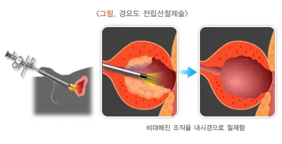 전립선비대증 비약물 치료 설명 이미지 1