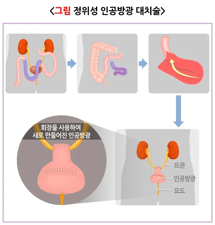 요로전환술(정위성 인공방광 대치술) 치료 방법 설명 이미지 1