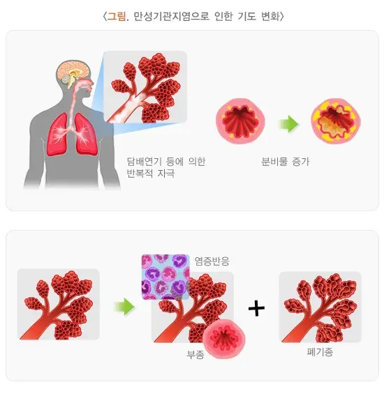 만성기관지염 병태생리 설명 이미지 1