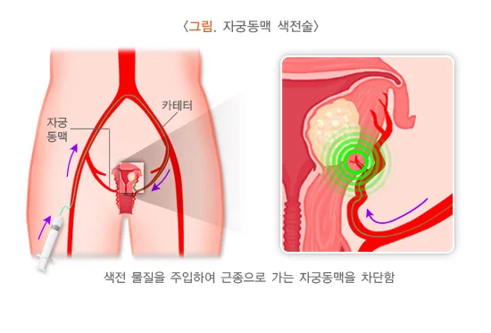 자궁근종 치료 설명 이미지 3