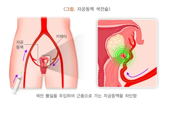 자궁근종 치료 설명 이미지 3