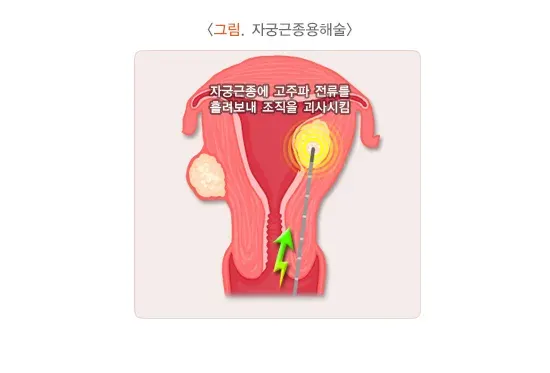 자궁근종 치료 설명 이미지 4