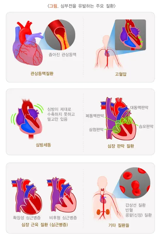 심부전 원인 설명 이미지 1