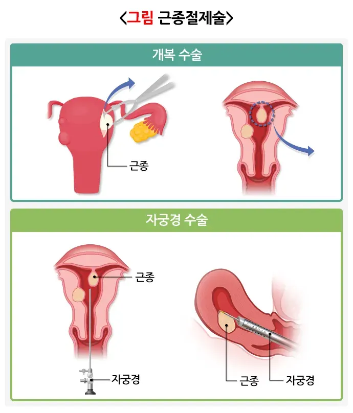 자궁근종 치료 설명 이미지 1