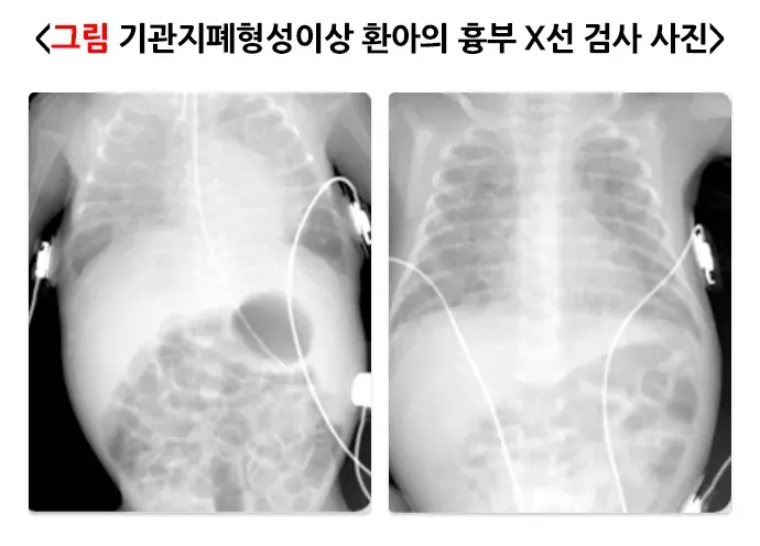 미숙아 합병증 설명 이미지 3