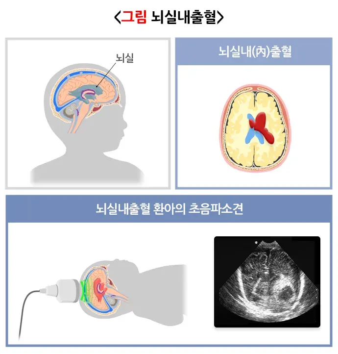 미숙아 합병증 설명 이미지 4