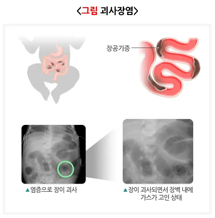 미숙아 합병증 설명 이미지 6